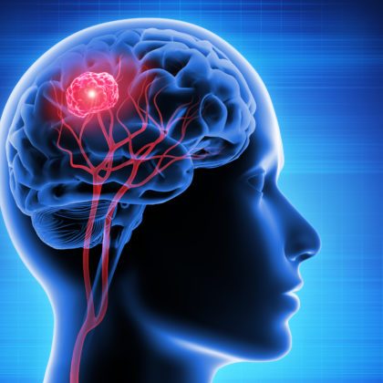 Eine farbige Illustration eines Kopfes im Profil mit Hirn und Hirntumor.